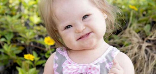 أسباب متلازمة داون أسباب متلازمة داون