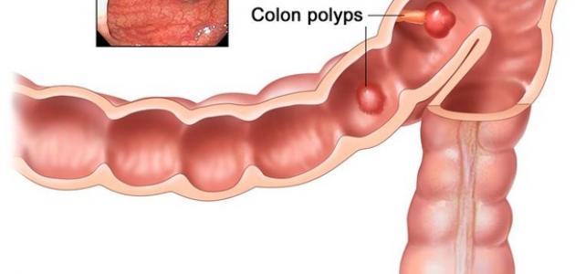 أسباب مرض القولون أسباب مرض القولون