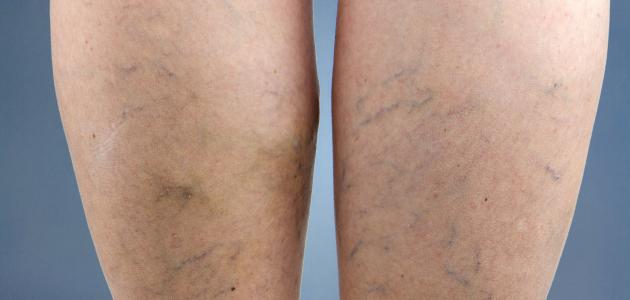 أسباب مرض دوالي الساقين أسباب مرض دوالي الساقين