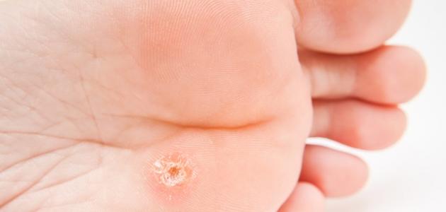 أسباب مسمار القدم أسباب مسمار القدم