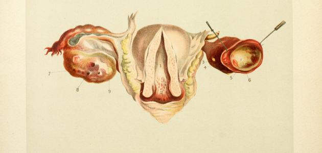 أضرار الكيس على المبيض