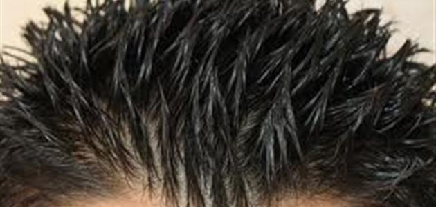 أضرار جل الشعر