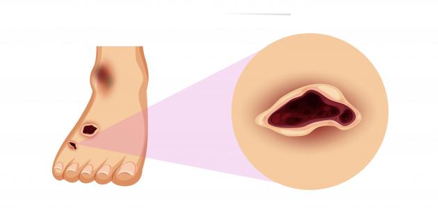 أضرار مرض السكر على النساء أضرار مرض السكر على النساء