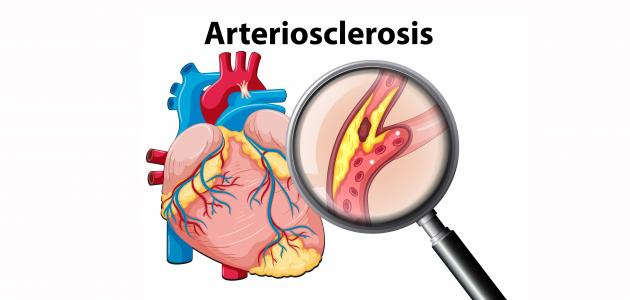 أعراض ارتفاع شحوم الدم
