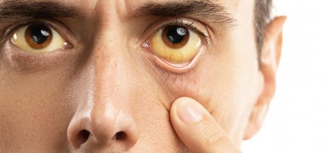 أعراض ارتفاع هيموجلوبين الدم أعراض ارتفاع هيموجلوبين الدم