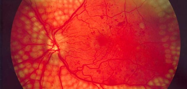 أعراض اعتلال الشبكية السكري أعراض اعتلال الشبكية السكري