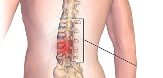 أعراض الانزلاق الغضروفي أسفل الظهر