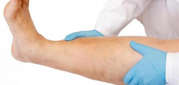 أعراض انسداد شرايين القدم أعراض انسداد شرايين القدم