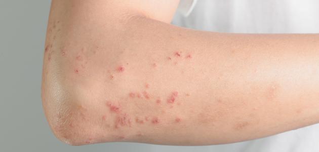 أعراض حساسية الجلد