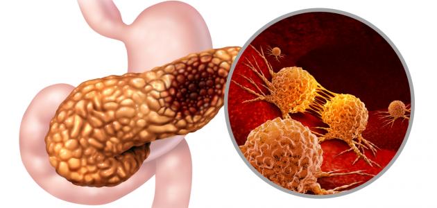 أعراض سرطان البنكرياس