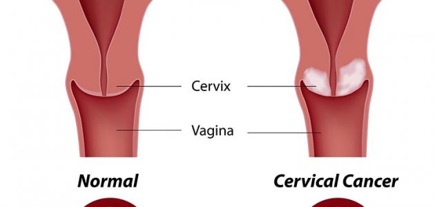 أعراض سرطان الرحم أعراض سرطان الرحم