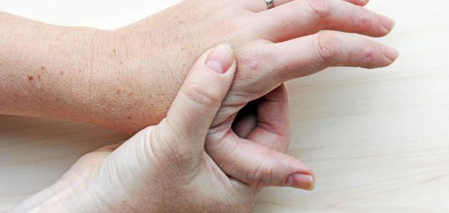 أعراض مرض النقرس - فيديو