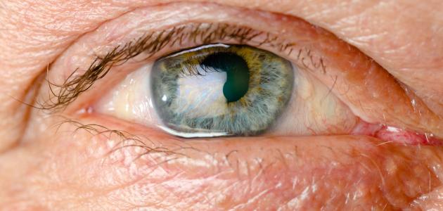 أعراض مرض ويلسون أعراض مرض ويلسون