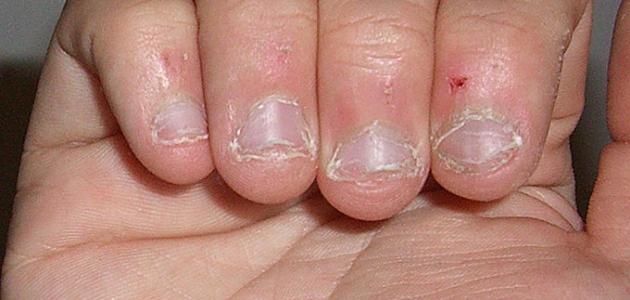 أعراض نقص هرمون الغدة الجار درقية أعراض نقص هرمون الغدة الجار درقية