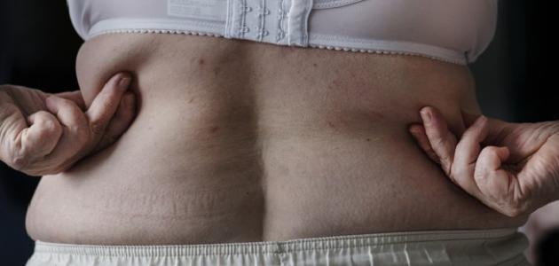 أفضل طريقة للتخلص من دهون الظهر