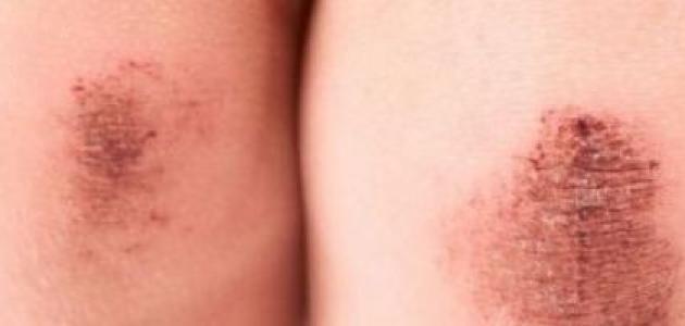 أنواع الجروح أنواع الجروح