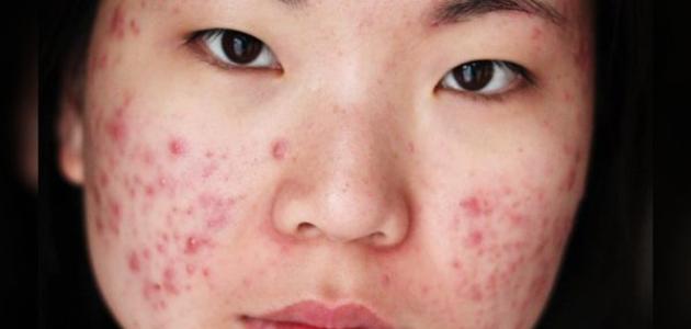 أنواع حب الشباب