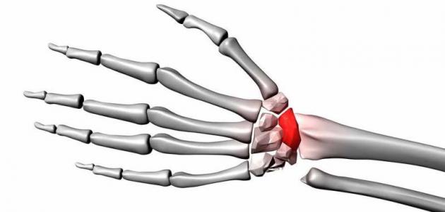 أنواع كسور العظام - فيديو أنواع كسور العظام - فيديو
