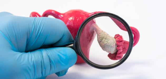 أورام المبيض أورام المبيض