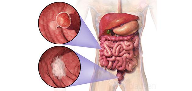 أورام المستقيم أورام المستقيم