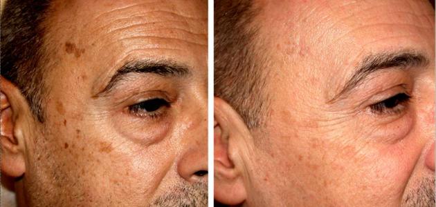 إزالة البقع من الوجه بسرعة إزالة البقع من الوجه بسرعة