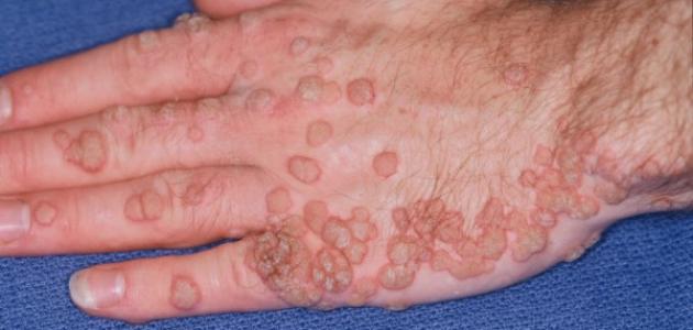 إزالة الثآلول إزالة الثآلول