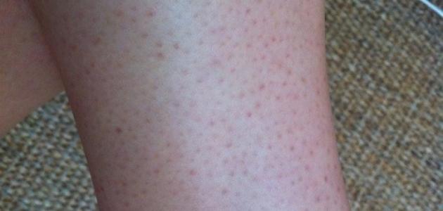 إزالة النقط السوداء من الساقين إزالة النقط السوداء من الساقين