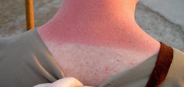 إزالة حروق الشمس منزلياً