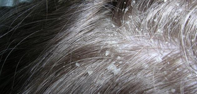 إزالة قشرة الشعر بخل التفاح إزالة قشرة الشعر بخل التفاح