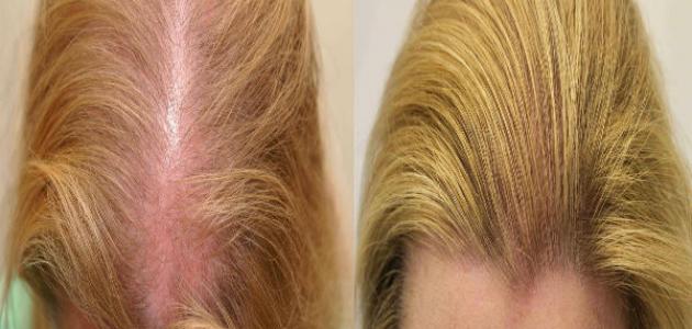 إنبات الشعر في مقدمة الرأس للنساء إنبات الشعر في مقدمة الرأس للنساء