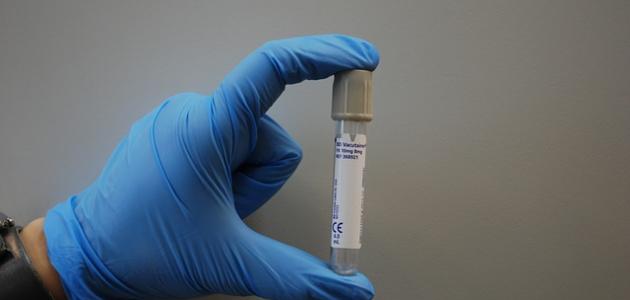 ارتفاع إنزيمات الكبد إلى 500 ارتفاع إنزيمات الكبد إلى 500