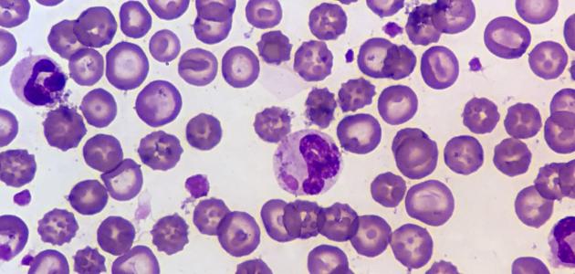 ارتفاع اليوريا في الدم ارتفاع اليوريا في الدم