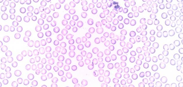 ارتفاع عدد كريات الدم البيضاء ارتفاع عدد كريات الدم البيضاء