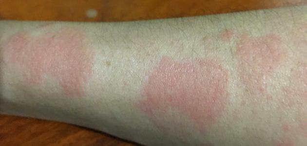 الاعراض الجلدية في الذئبة الحمراء الاعراض الجلدية في الذئبة الحمراء