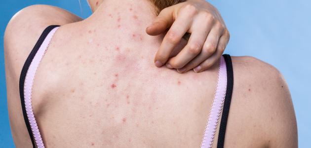 التخلص من آثار الحبوب في الجسم التخلص من آثار الحبوب في الجسم