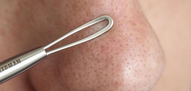 التخلص من الزيوان على الأنف