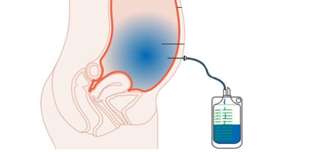 التخلص من سوائل البطن التخلص من سوائل البطن