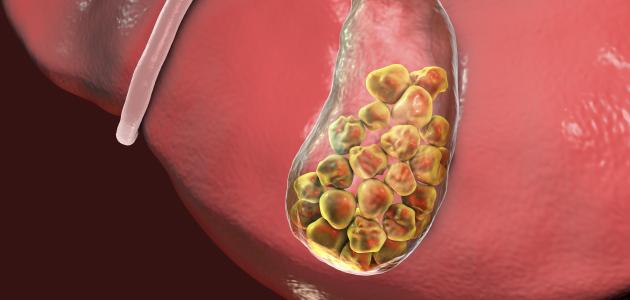 الحصوة في الكلى الحصوة في الكلى