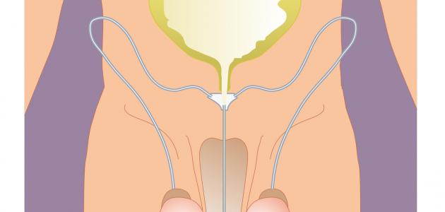 الخصية الهاربة