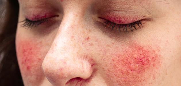 الخطوط الحمراء بالجسم وأسبابها الخطوط الحمراء بالجسم وأسبابها