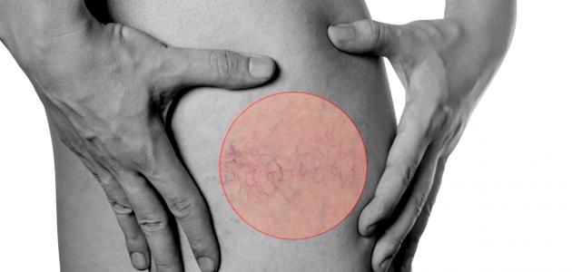 الدوالى وكيفية علاجها