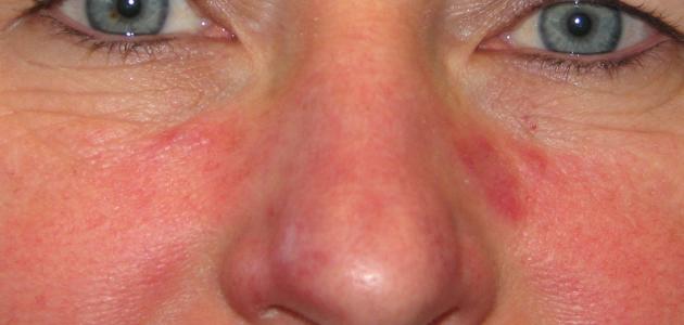 الذئبة الحمراء والقلب الذئبة الحمراء والقلب