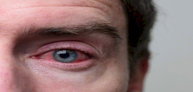 العين الحمراء العين الحمراء