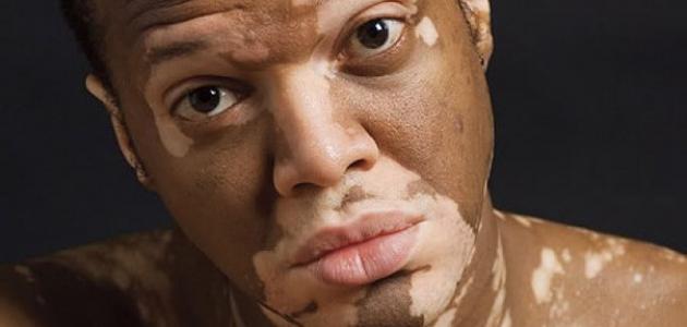 الفرق بين النخالة البيضاء والبهاق الفرق بين النخالة البيضاء والبهاق