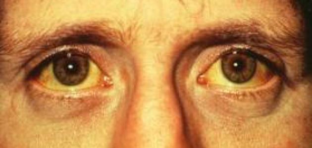 الكبد واصفرار العين الكبد واصفرار العين