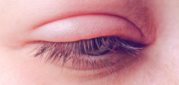 الكيس الدهني في جفن العين العلوي الكيس الدهني في جفن العين العلوي