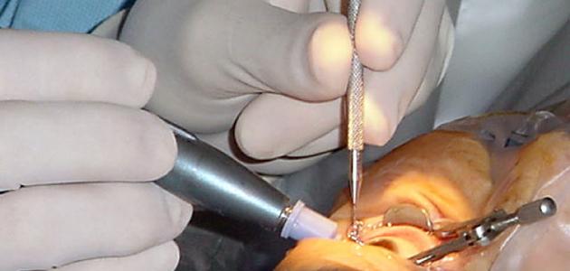 الماء الأبيض في العين أسبابه وعلاجه الماء الأبيض في العين أسبابه وعلاجه