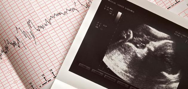 الموجات فوق الصوتية للتأكد من الحمل