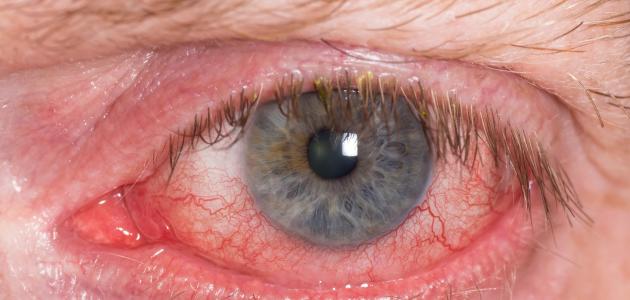 المياه الزرقاء في العين المياه الزرقاء في العين