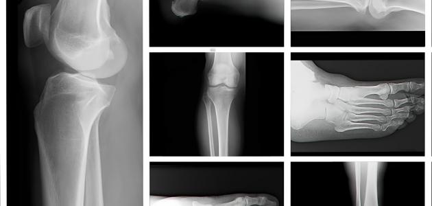 انواع الكسور انواع الكسور